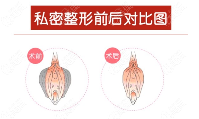 私處整形價格概覽，背景、時代印記與費用探討